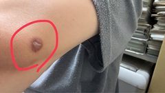 1433  火傷🤯🤯🤯